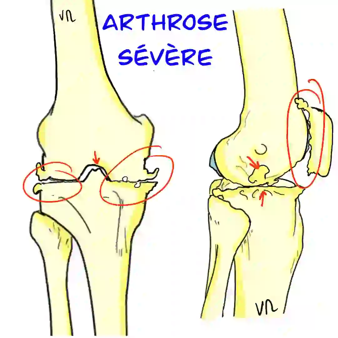 genou arthrosique