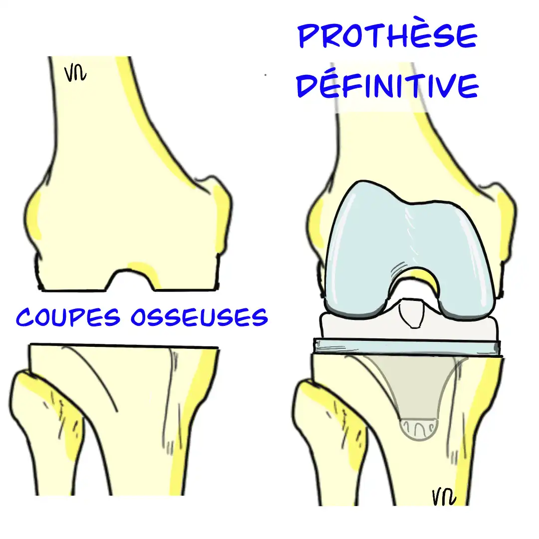 Prothese definitive