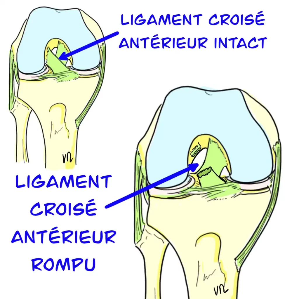 Side-by-side knee anatomy diagram illustrating intact ACL and torn ACL conditions