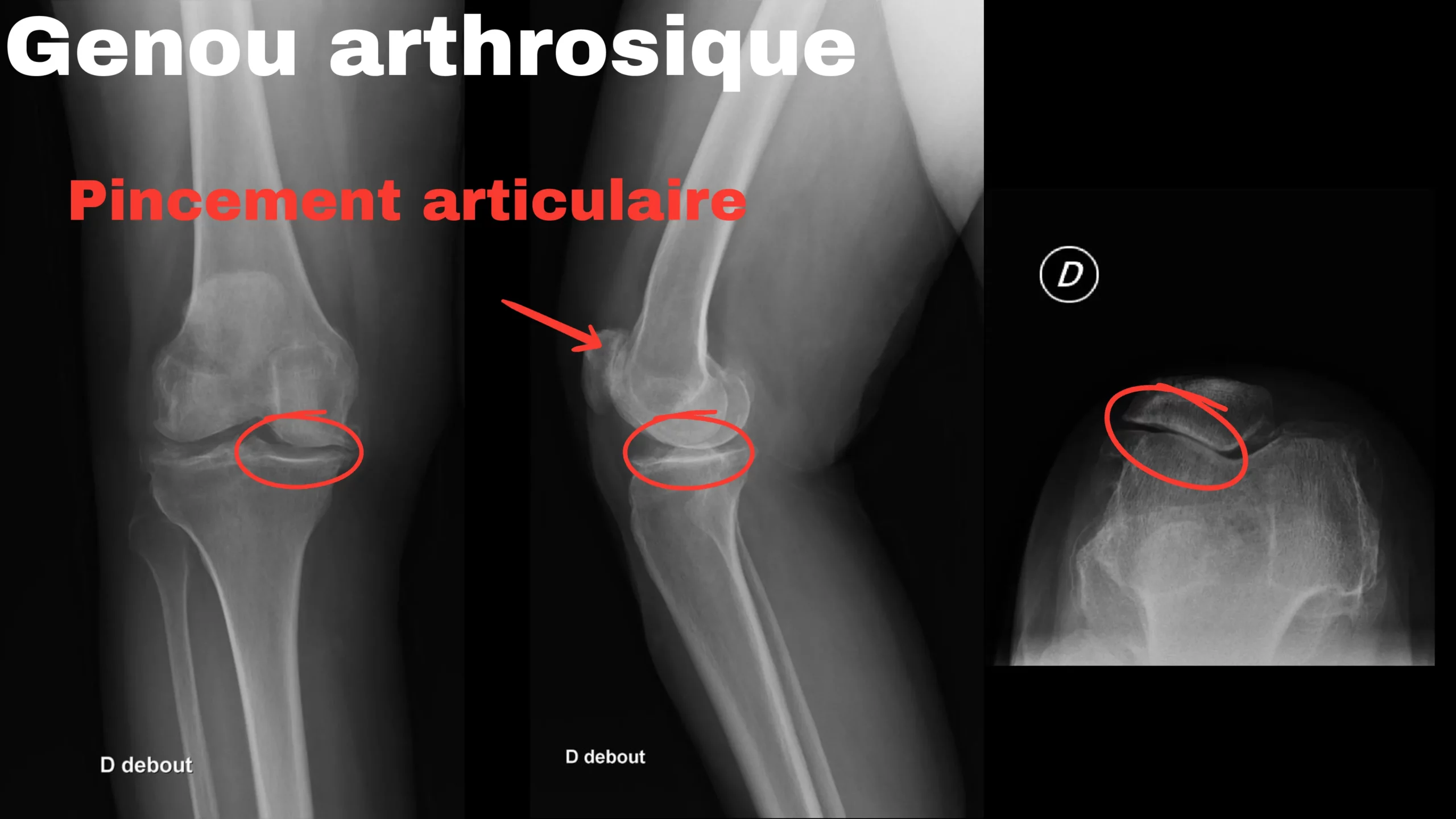genou arthrosique