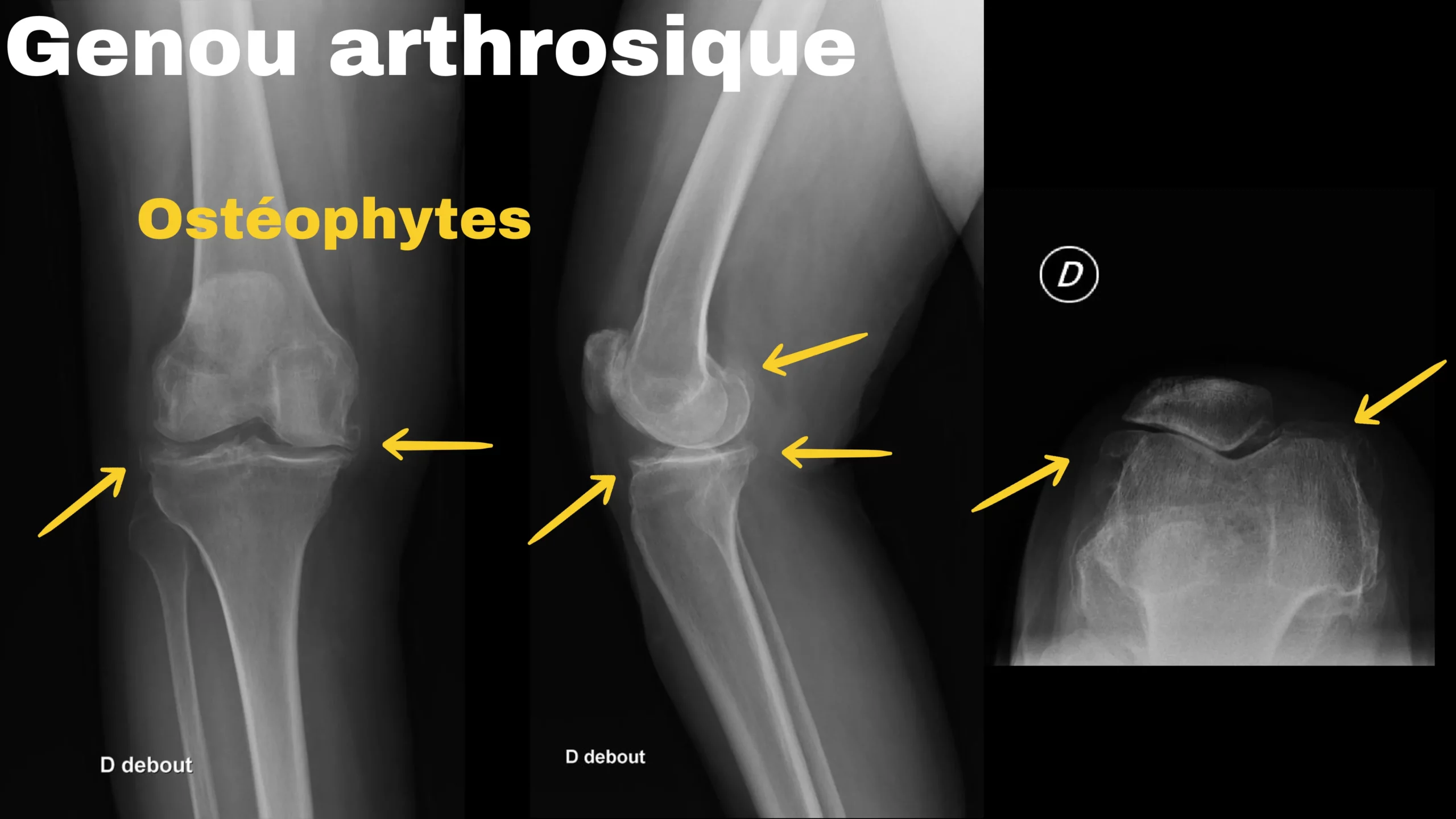 Genou arthrosique