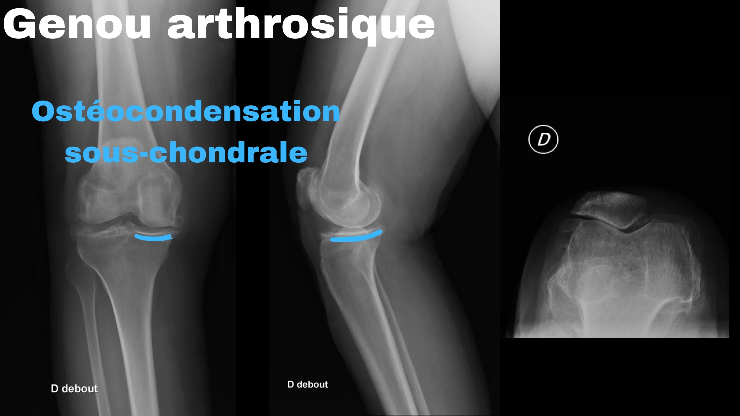 genou arthrosique