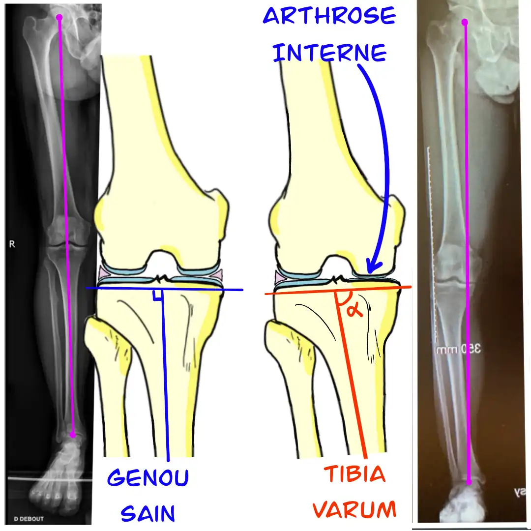 Arthrose interne