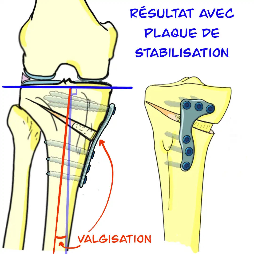 resultat avec plaque de stabilisation