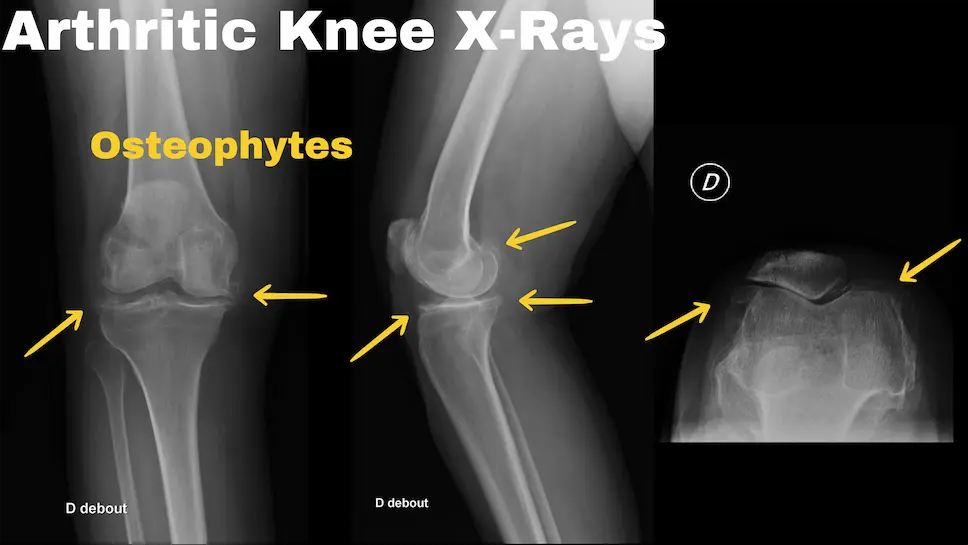 Genou arthrosique