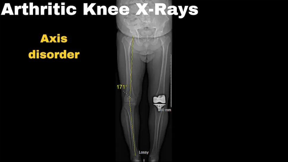 Genou arthrosique