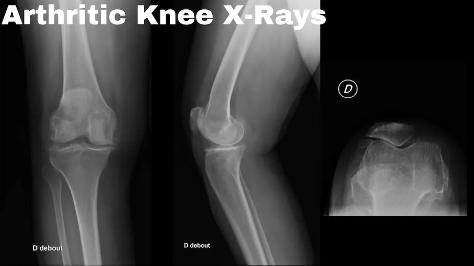 Genou arthrosique