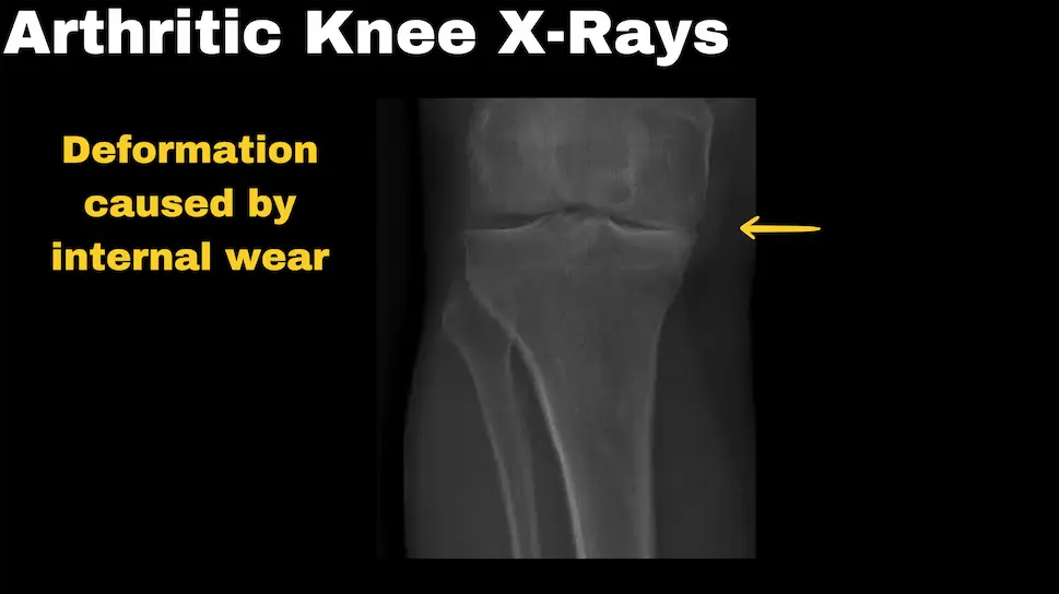 Genou arthrosique