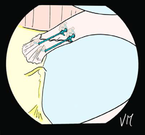 Arthroscopic meniscal repair with two anchors.