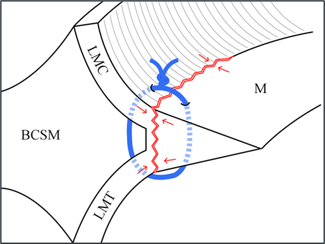 Meniscal tear involving medial collateral and meniscotibial ligaments.