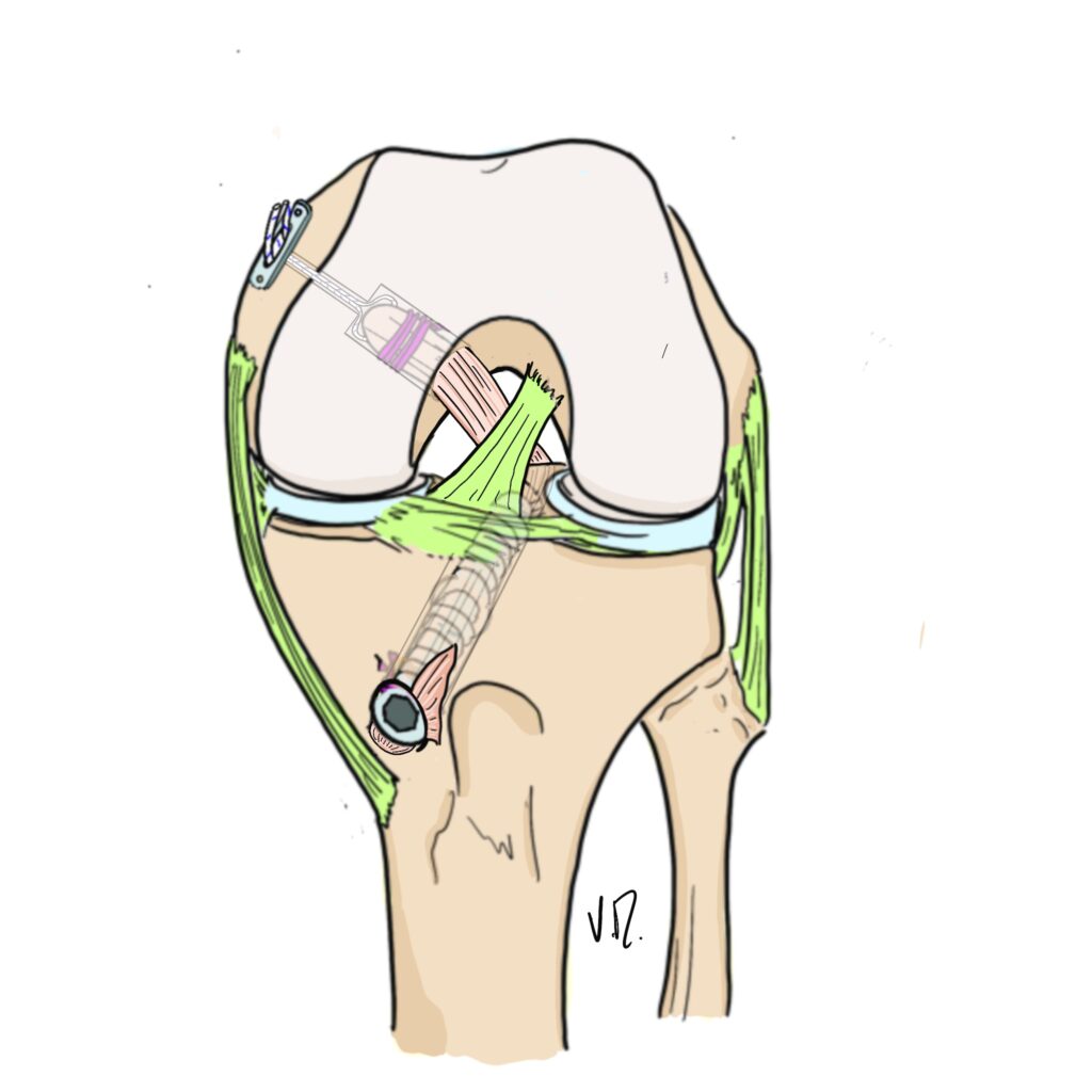 Anatomical diagram of the posterior cruciate ligament (PCL) inside the knee joint.