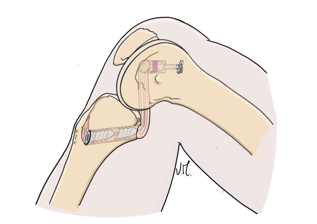 Surgical diagram showing arthroscopic reconstruction of the posterior cruciate ligament with tendon graft.