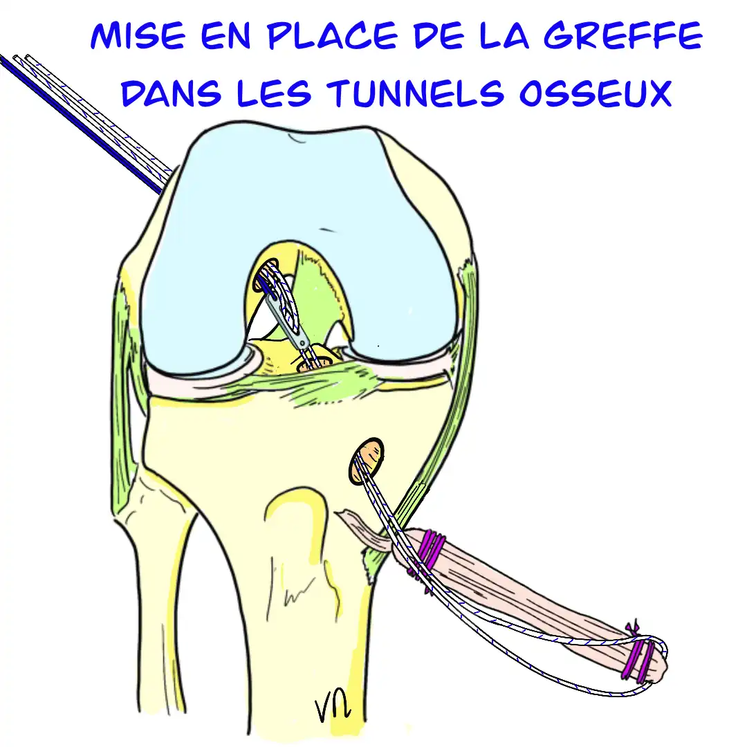 Mise en place de la greffe