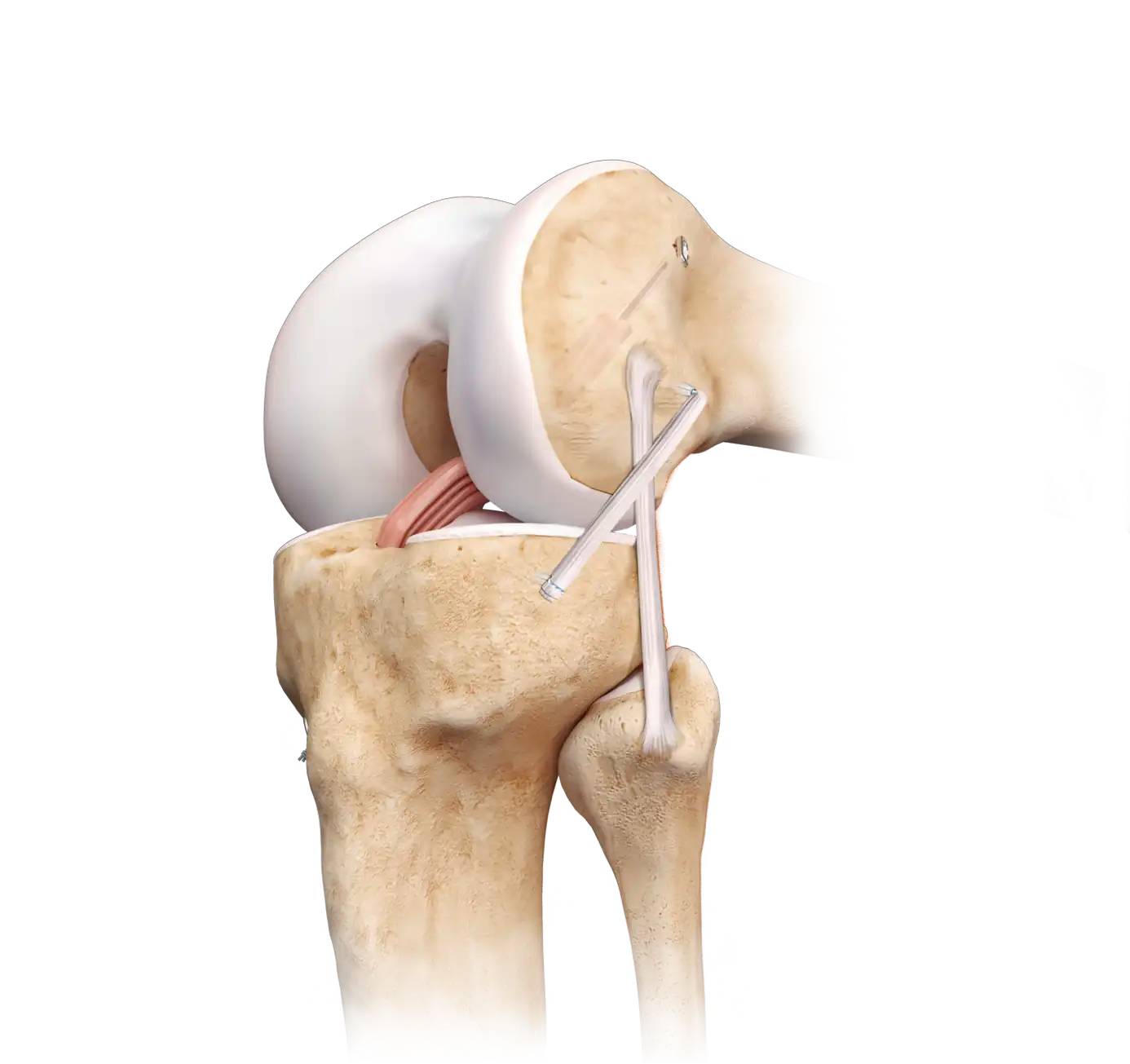 Ligamentoplastie Avec Stabilisation