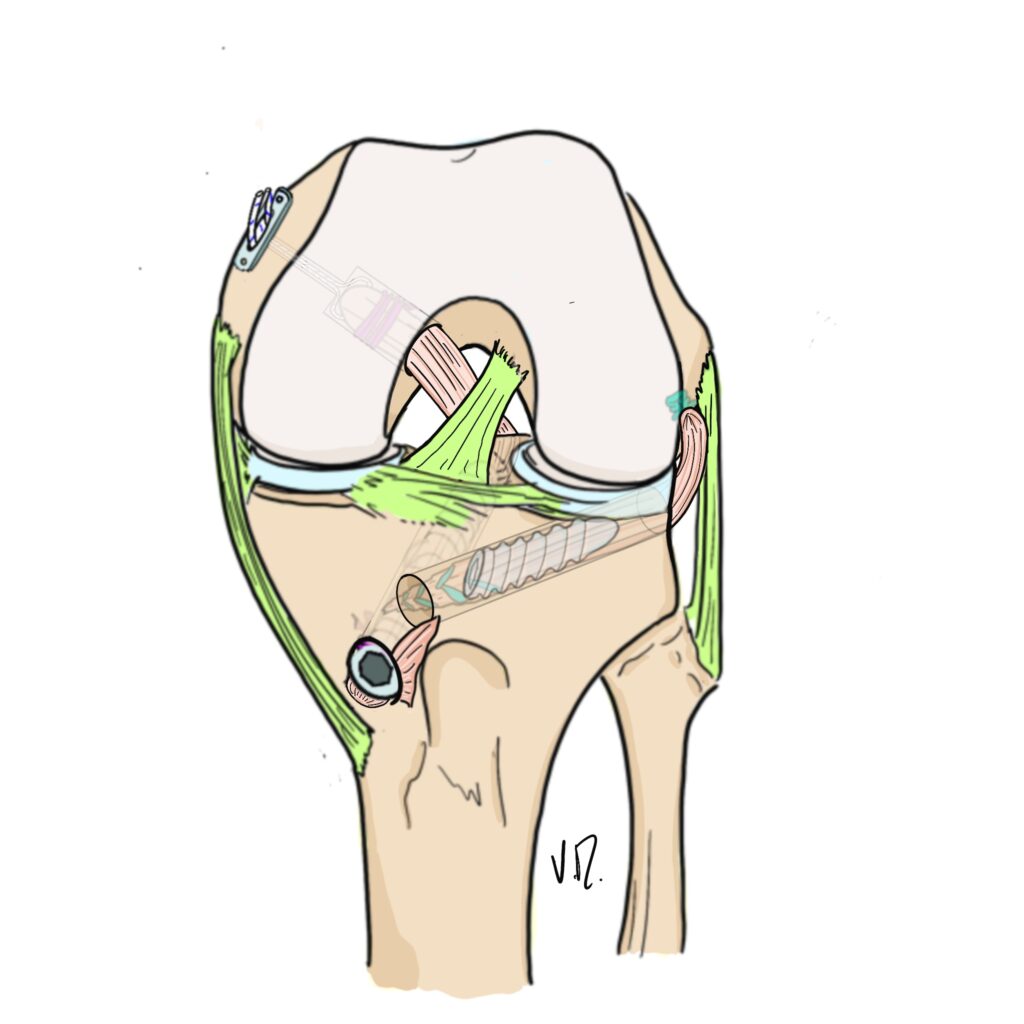 Diagram illustrating posterior cruciate ligament reconstruction technique with bone tunnels.