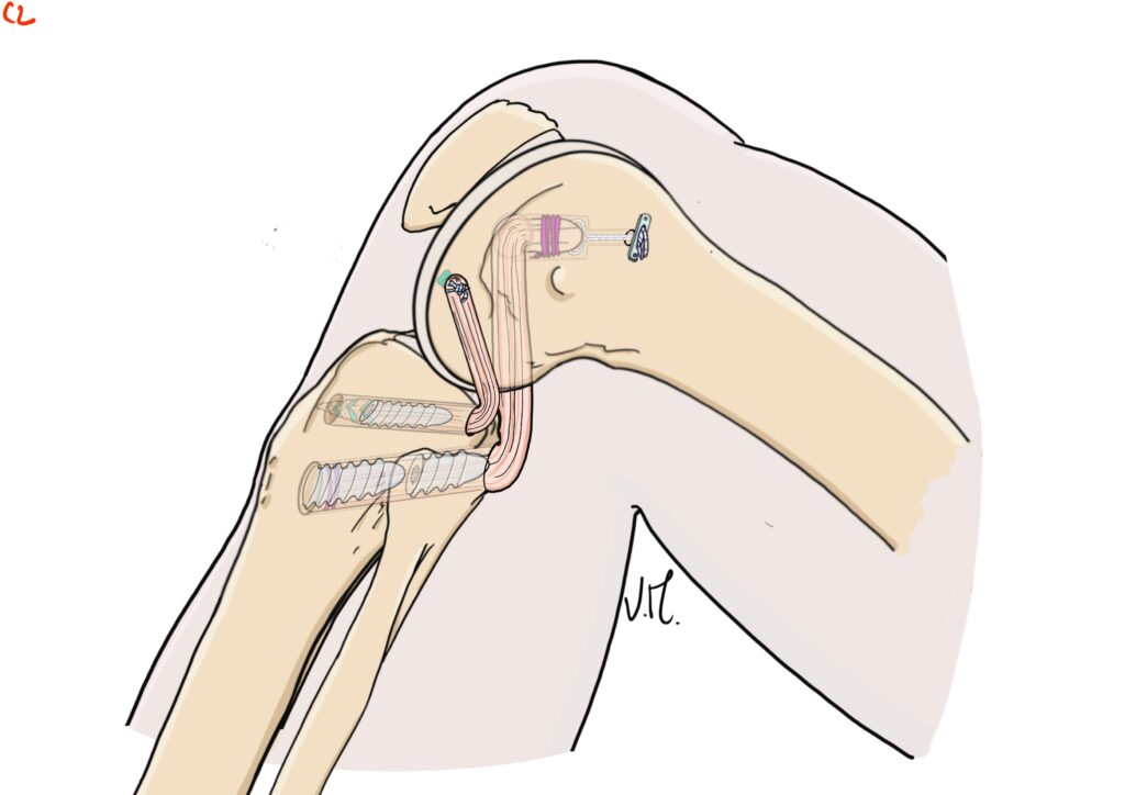 Medical diagram of graft fixation during posterior cruciate ligament reconstruction.