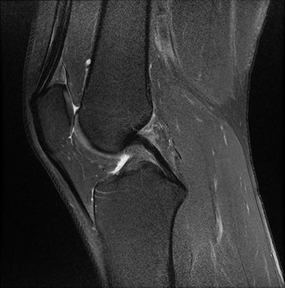Sagittal knee MRI illustrating the posterior cruciate ligament (PCL) anatomy.