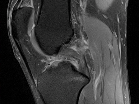 Sagittal MRI of the knee illustrating posterior cruciate ligament (PCL) tear.
