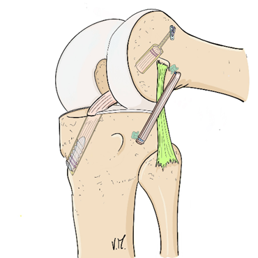 Pedicled, socketed DT3 + independent ALL, lateral view.