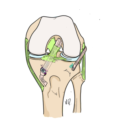 DT3 for ACL + ALL (anterior view).