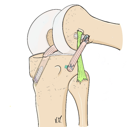 DT3 for ACL + ALL (lateral view).
