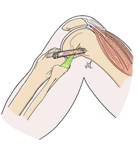 Rectus femoris graft, side view.