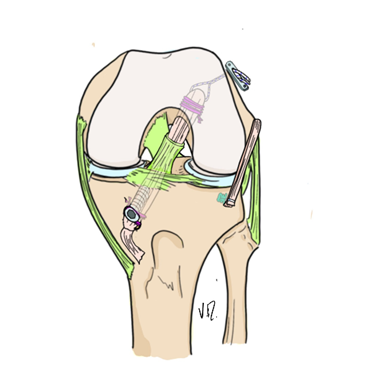 Pedicled, socketed DT3 + independent ALL, anterior view.